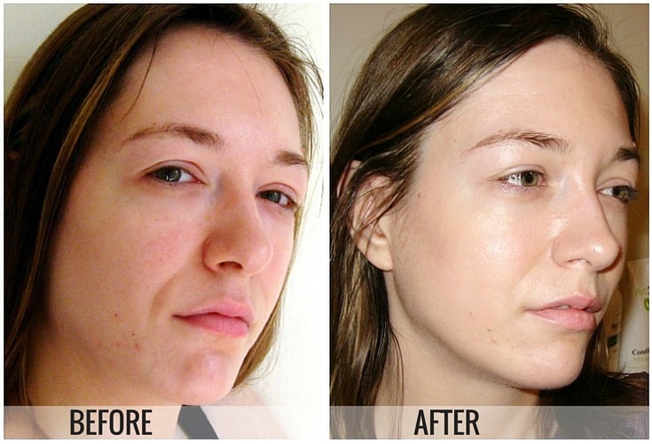 destination skin facial before and after