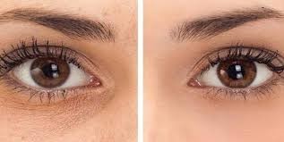 قبل و بعد از استفاده از کرم دور چشم