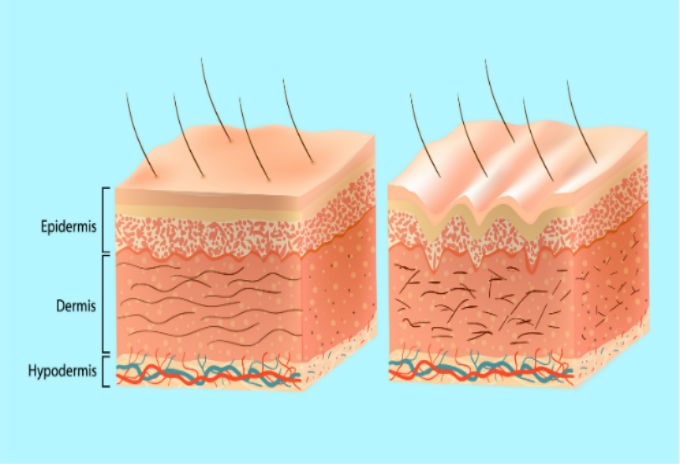 پوست و لایه های آن و درمان لکه های پوستی