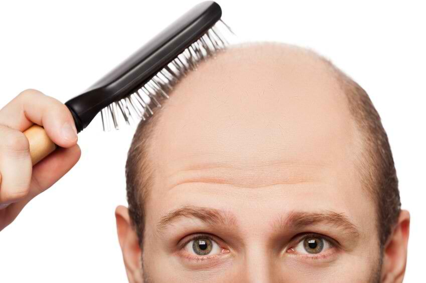 ریزش مو ارثی چیست؟