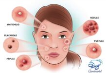 انواع جوش صورت همراه با روش های تضمینی درمان